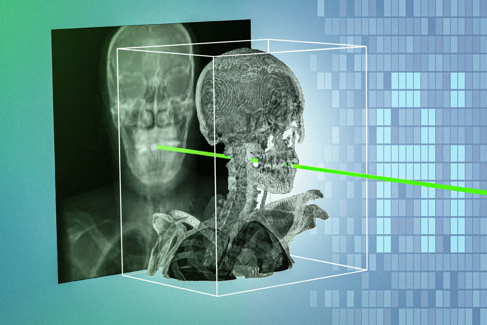 New AI method aligns X-rays with 3D scans for surgery